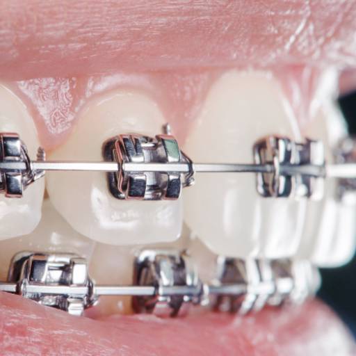 Aparelhos Ortodônticos – Sorriso Alinhado e Saúde Bucal em Lençóis Paulista/SP