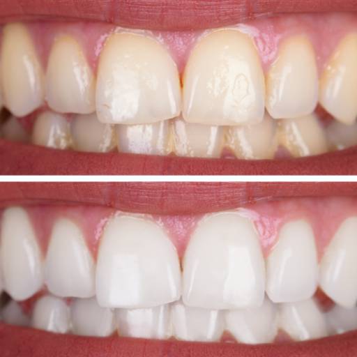 Clareamento Dentário – Sorriso Mais Branco e Confiante em Lençóis Paulista/SP