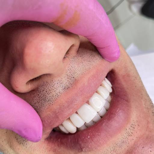 Sorriso Perfeito com Resina de Qualidade em Avaré - SP