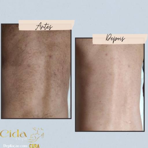 Depilação Costas por Espaço Cida Depil