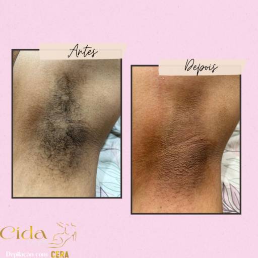 Depilação Axila  por Espaço Cida Depil