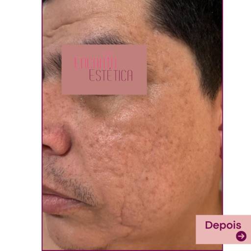 Microagulhamento – Redução de Cicatrizes de Acne com Estímulo Natural de Colágeno – Rio de Janeiro, RJ por Encanto Estética