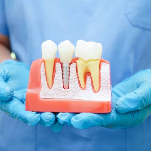 Implante Dentário – Sorriso completo e duradouro | Lençóis Paulista