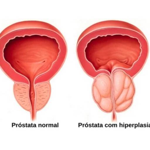 Tratamento de Hiperplasia de Próstata (HPB) em Juiz de Fora