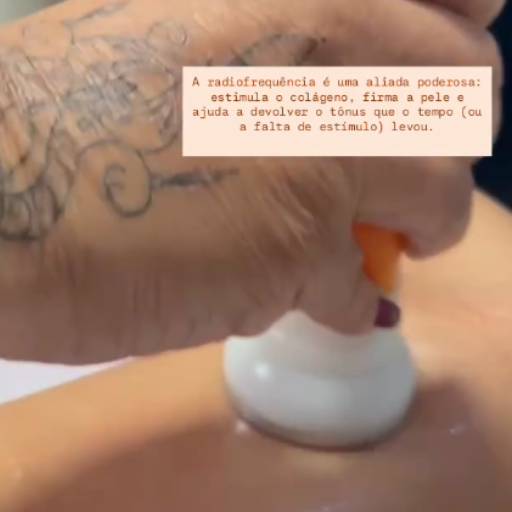 Radiofrequência em Novo Gama – Rejuvenescimento e Firmeza para Sua Pele