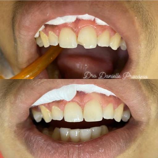 Reabilitação Oral em Hortolândia – Odonto Los Angeles