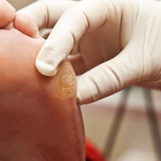 Remoção de Calos e Calosidades por Clinica Gander Podologia e Reflexologia