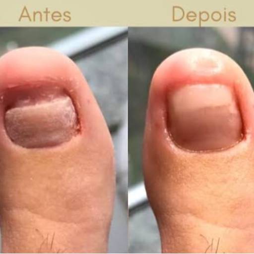 Reconstrução de unhas por Clinica Gander Podologia e Reflexologia