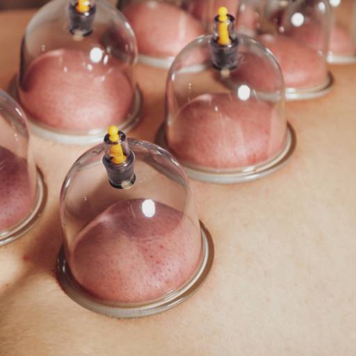 Ventosaterapia em Jundiaí por Casa do Massagista César Depil