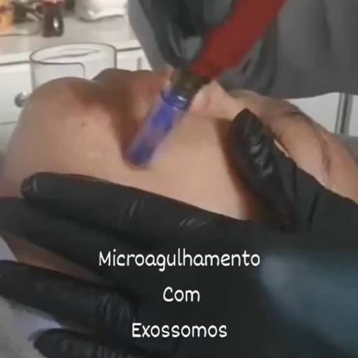 Microagulhamento em São Manuel – Rejuvenescimento com Resultados Visíveis por Saúde Viva e Estética