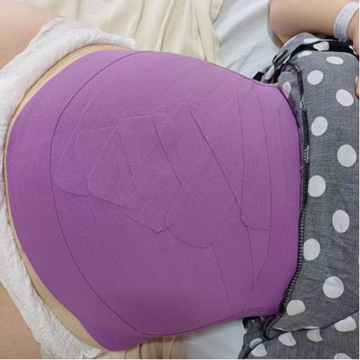 Taping Pós-Parto em Avaré – Recuperação Segura com Técnica Não Invasiva por Labella Consultório de Enfermagem e Laserterapia