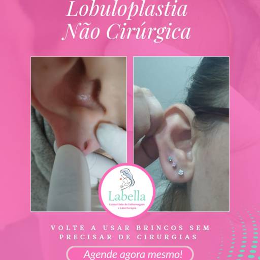 Lobuloplastia Não Cirúrgica em Avaré – Recuperação Estética Sem Cirurgia