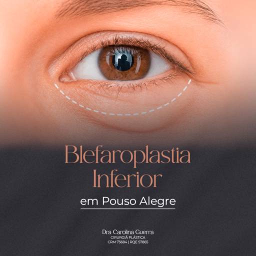 Blefaroplastia Inferior em Pouso Alegre