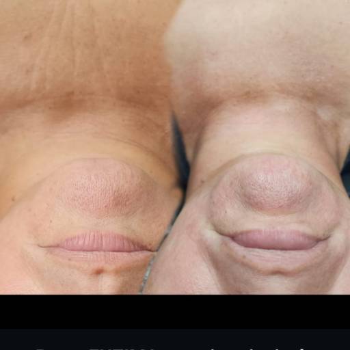 Proxy Enzima em Ourinhos – Rejuvenescimento Facial por Kely Massoterapia