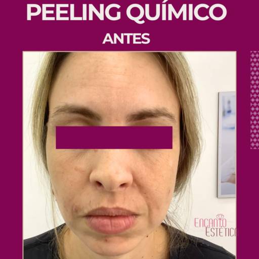 Peeling Químico – Pele Renovada e Radiante no Rio de Janeiro por Encanto Estética