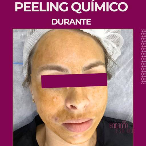 Peeling Químico – Pele Renovada e Radiante no Rio de Janeiro por Encanto Estética