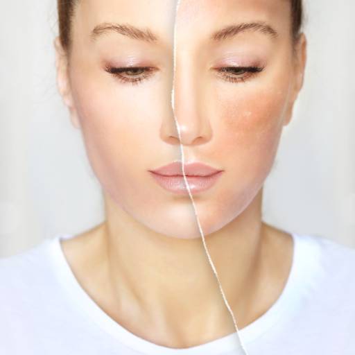 Tratamento de Manchas por Mayara Renie - Estética e Spa