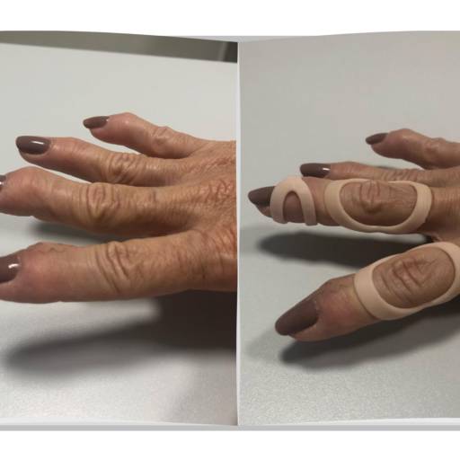 Anel em Oito em Impressão 3D - Prevenção e Correção de Deformidades em Ribeirão Preto/SP