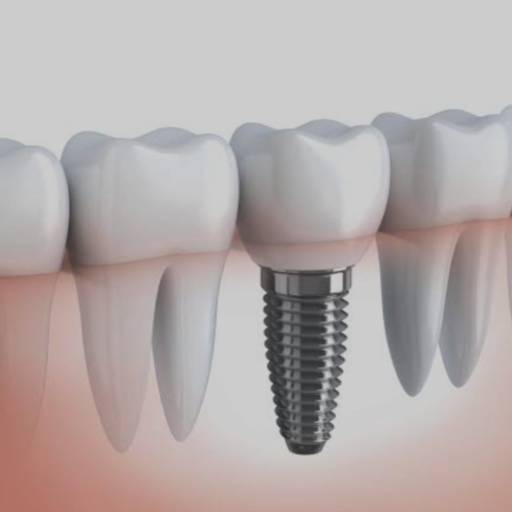 Implantes Dentários Porcelana - Beleza e Durabilidade - Macatuba