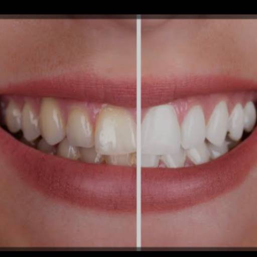 Clareamento - Indolor, Seguro e Rápido - Macatuba