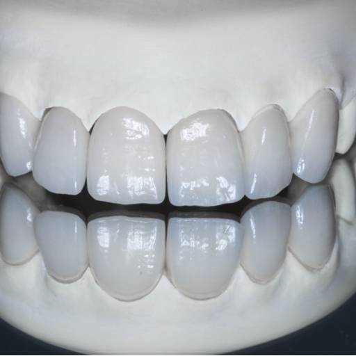 Facetas e Lentes: Sorriso Estético e Natural em Uberlândia/MG