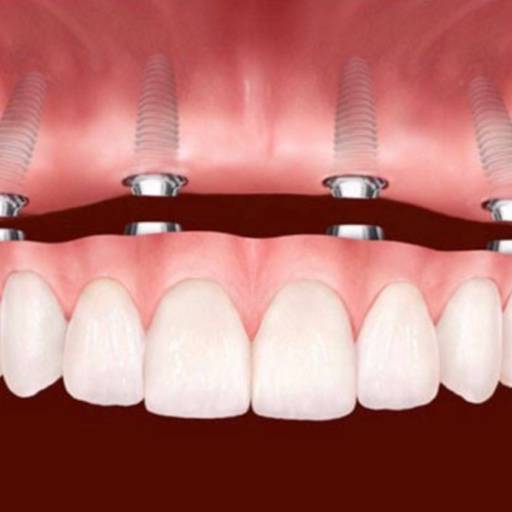 Comprar o produto de Implantes dentários  em A Classificar pela empresa Clínica Odontológica Estar Bem em Assis, SP por Solutudo
