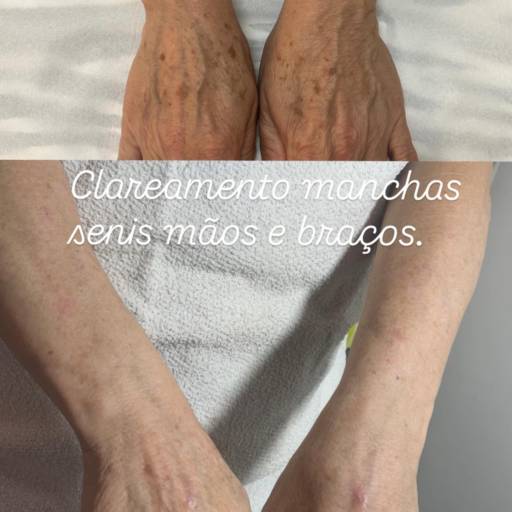 Clareamento de Manchas – Espaço Vip Estética