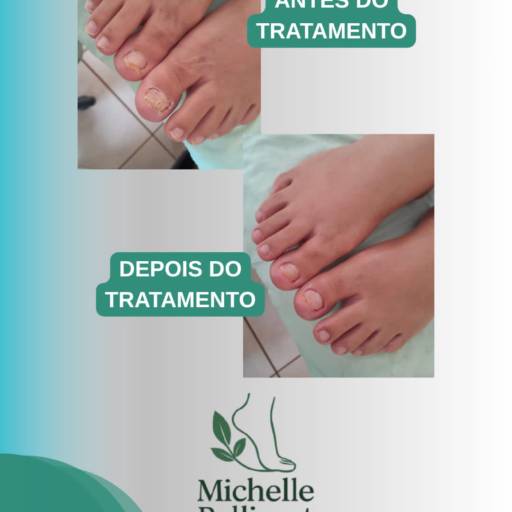 Podologia em Santa Helena de Goiás – Saúde e Conforto para Seus Pés