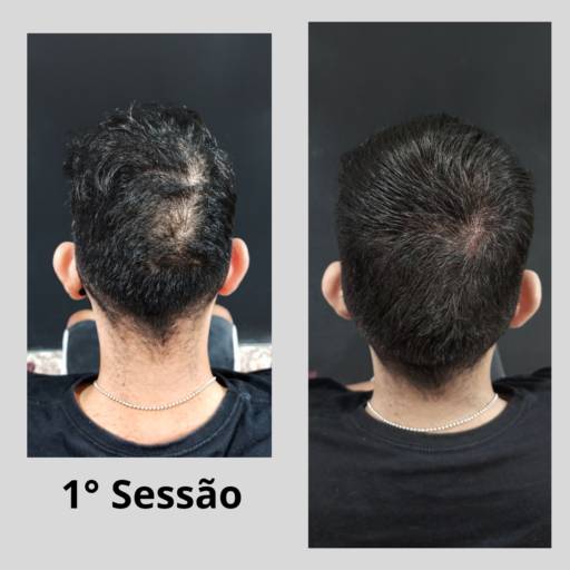 Micropigmentação Capilar