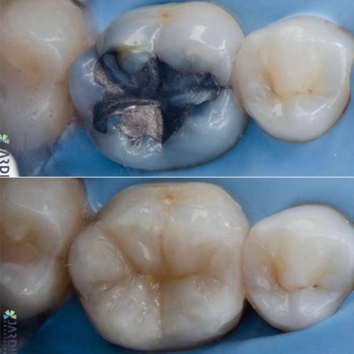 Restauração de Dentes Posteriores em Francisco Beltrão