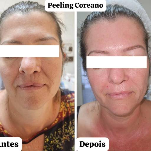 Peeling Coreano em Avaré – Centro de Estética Boa Forma