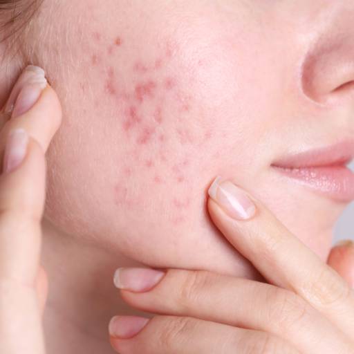 Tratamento para Acne