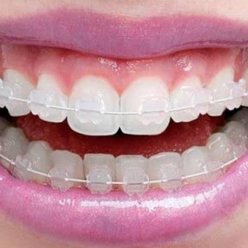 Comprar o produto de Aparelhos Ortodonticos em A Classificar pela empresa Dra Nathália Quirino Bueno em Bauru, SP por Solutudo