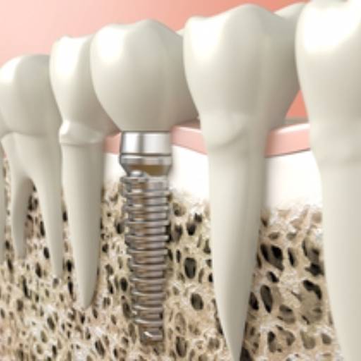 Comprar o produto de Implantes dental em A Classificar pela empresa Vech Dental Care - Vladimir A. Risso em Jundiaí, SP por Solutudo