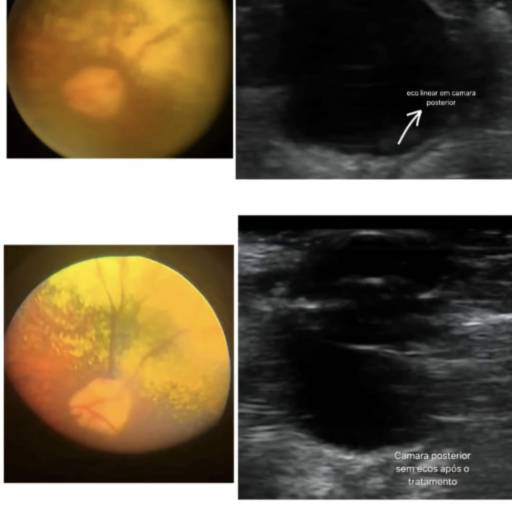 exame de ultrassom efetuado no globo  ocular para fins de diagnóstico de problemas de câmara posterior,  descolamento de retina e nódulos retrobulbares