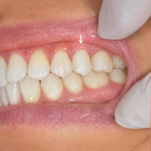 Coroa de Porcelana / Prótese Fixa em São José dos Campos: Sorriso Natural