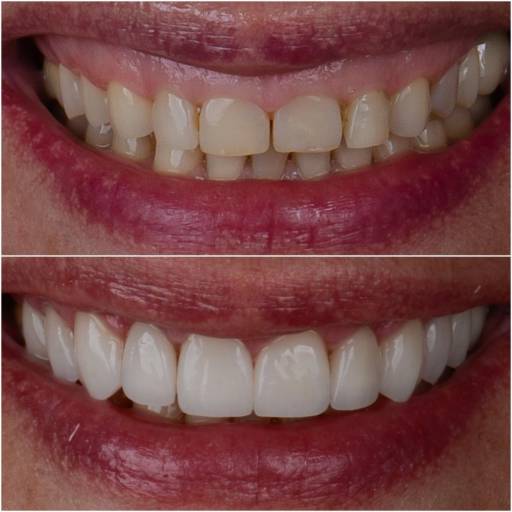 Sabe aquela pessoa que quando sorri a gengiva aparece em excesso? A Cirurgia Plástica Gengival harmoniza o sorriso. Ao corrigir o contorno da gengiva, é possível equilibrar a estética branca dos dentes com a estética vermelha da gengiva, revelando dentes proporcionais e uma linha do sorriso natural e saudável. 
Também podemos lançar mão dessa técnica para pequenas correções de assimetrias gengivais ou ainda como uma preparação estética para facetas, lentes ou restaurações.
Mais do que transformar a aparência, a cirurgia plástica gengival recupera a confiança para sorrir plenamente.