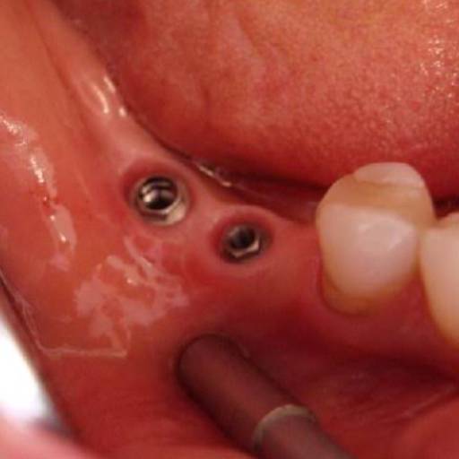 Protese sobre implante - COROA  por Dra. Nathália Quirino Bueno