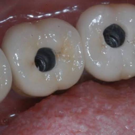 Protese sobre implante - COROA  por Dra. Nathália Quirino Bueno