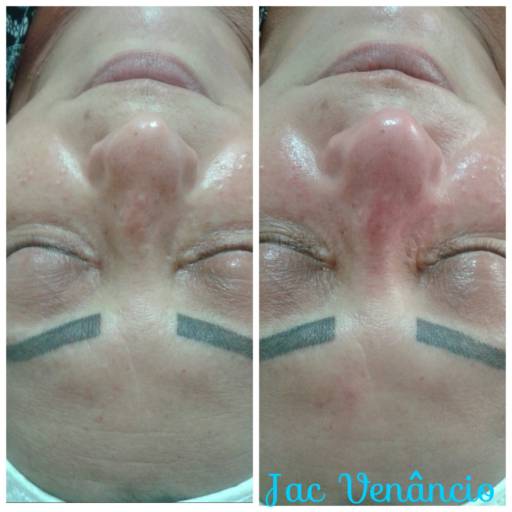 Limpeza de pele com peeling de diamante por Jac - Estética e Acupuntura