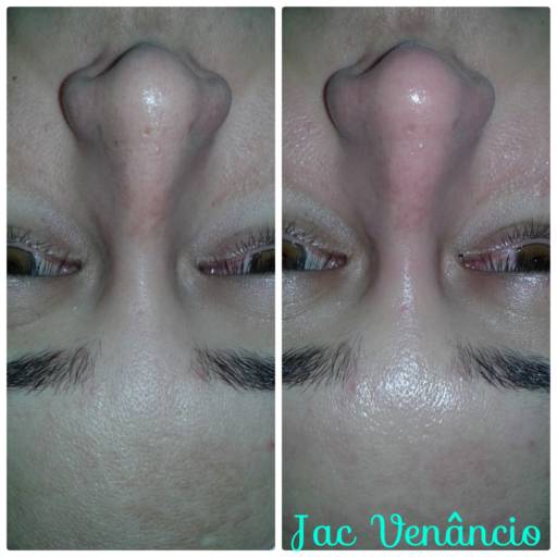 Limpeza de pele com peeling de diamante por Jac - Estética e Acupuntura
