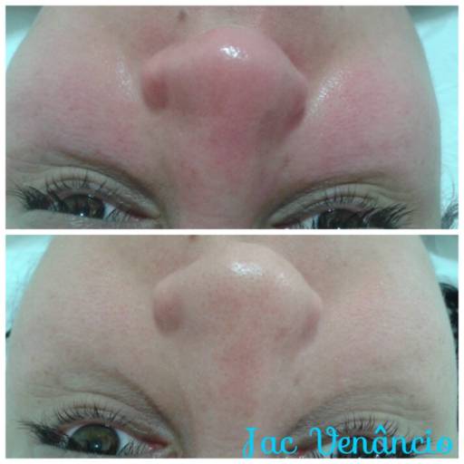 Limpeza de pele com peeling de diamante por Jac - Estética e Acupuntura