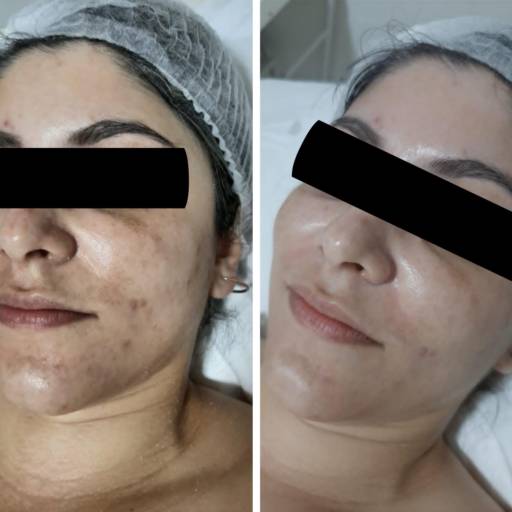 Limpeza de Pele e Peeling em Avaré – Renovação e Vitalidade