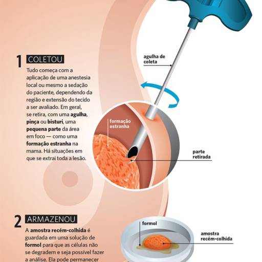 BIOPSIA por LAP - Laboratório de Anatomia Patológica 