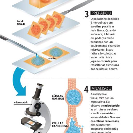 BIOPSIA por LAP - Laboratório de Anatomia Patológica 