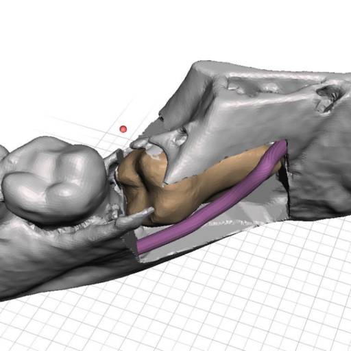 Impressão 3D<br /> Confecção de Biomodelo em 3D por Top Radio - Radiologia Odontológica em Atibaia