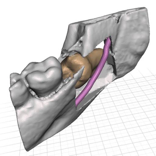 Impressão 3D<br /> Confecção de Biomodelo em 3D por Top Radio - Radiologia Odontológica em Atibaia