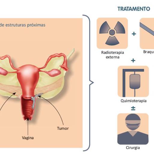 Colposcopia, Exame de Lamina, Papa Nicolau por Clinvida