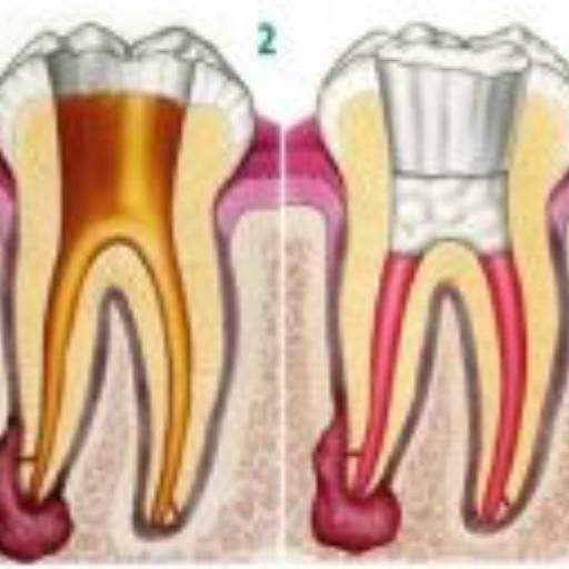 Tratamento de canal por Dra. Nathália Quirino Bueno