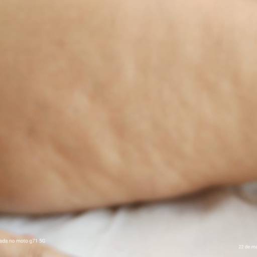 Massagem para Lipedema